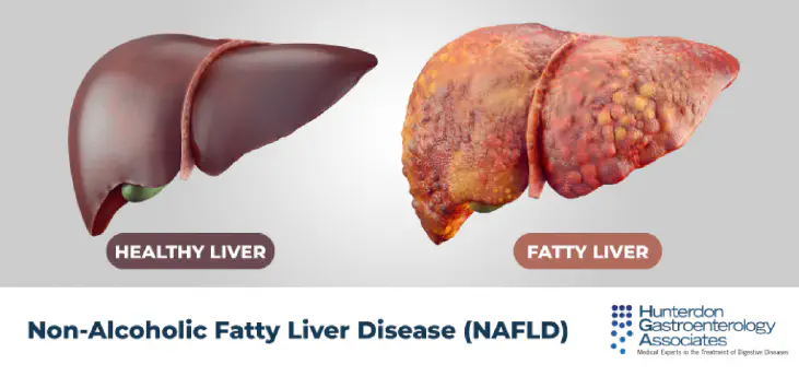 liver, healthy, fatty